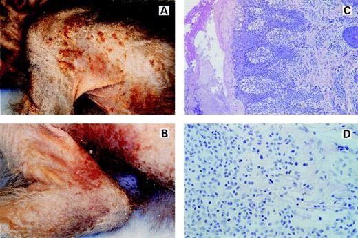 Fig. 1. Macroscopic and histologic characteristics of a skin lesion in the lymphomatous macaque. (A) and (B) show the macroscopic appearance of the lesions present in pigtailed macaque J94356. Note the extensive areas of involvement. The lesions are hyperkeratotic, with alopecia, and with excoriated areas surrounded by prominent borders. (C) shows a low-power magnification of the histology of a skin lesion stained with Hematoxylin and Eosin (HE). Note the profuse mononuclear cell infiltration of the dermis, dermal-epidermal junction, epidermis, periadnexal tissue, and perivascular areas. (D) shows a high-magnification view (400×) of the infiltrating cells stained with HE. Numerous mitotic figures are present on a homogeneous background. The cells have moderately sized nuclei with 1 or 2 nucleoli.