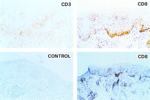 Fig. 2. Identification of the phenotype of neoplastic cells infiltrating the skin. Top left panel (CD3) shows an area of affected skin stained with monoclonal antibodies against CD3. Clusters of CD3+ cells are present along the dermal-epidermal junction and in the epidermis. Top and lower right panels (high-and low-power magnification, respectively) demonstrate that the infiltrating cells belong to the CD8+ T-cell subgroup. Cells strongly positive for CD8 are present in clusters in the dermis along the dermal-epidermal junction and in the epidermis. Lower left panel is a control for antibody specificity.