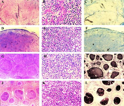 Fig. 1. (A through C) Parotid gland MALT lymphoma. Low magnification (A) shows diffuse infiltrate with numerous lymphoepithelial lesions. High magnification (B) shows centrocyte-like cells invading ductal epithelium. The lymphoma is CD10−(C) in contrast to residual reactive follicle centers. (D through F) Cervical lymph node. Low magnification (D) shows effacement of lymph node architecture by a diffuse infiltrate of centrocyte-like cells seen at high magnification (E). The tumor cells are CD10− (F), but small clusters of CD10+ residual follicle center cells are present. (G through I) Inguinal lymph node showing the features of follicular lymphoma at low magnification (G) and high magnification (H). The tumor is CD10+ (I). (J through L) Spleen showing involvement by follicular lymphoma at low magnification (J), high magnification (K), and CD10 expression (L).