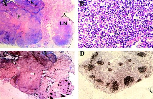 Fig. 2. Low magnification (A) shows parotid infiltrated by MALT lymphoma (P) and intraparotid lymph node (LN) with preservation of normal architecture. High magnification of intraparotid lymph node follicle center (B) shows centrocytes with occasional centroblasts and absence of tingible body macrophages. Immunostaining with CD10 (C) shows absence of staining in MALT lymphoma. The lymph node follicle centers are positive and emphasize the normal nodal architecture. Expression of bcl-2 protein by the lymph node follicle centers (D) is indicative of the neoplastic nature of the follicle center cells.