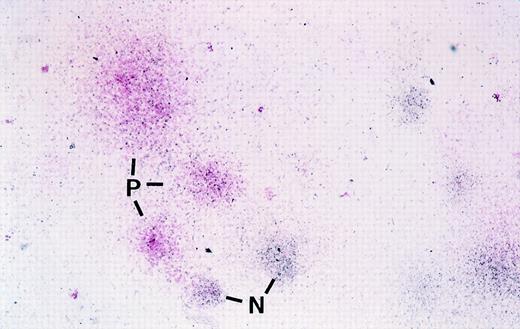 Fig. 2. Photomicrograph showing mCD24 expression in cells in colonies derived from transduced primate CFC using in situ labeling in agarose with anti-mCD24 followed by Streptavidin-conjugated alkaline phosphatase and development of the positive pink color reaction using Fast Red Substrate. In this photograph, colonies are counterstained blue-black with hematoxylin. Pink colonies are those that contain cells expressing the mCD24 transduced gene. In this low-magnification photomicrograph, 3 mCD24-positive pink colonies (P) and 2 of the several negative blue colonies (N) are indicated. No pink colonies were seen in any colony assays performed using progenitors that were not transduced (not shown). For actual visual scoring it is easier to count the total number of pink colonies in an agarose disk before counterstaining, where negative colonies show no color, and then score total colonies in the same disk after counterstaining.