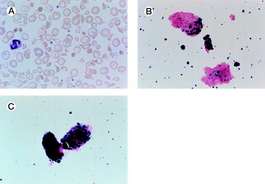Renal Hemosiderosis Due to Intravascular Hemolysis. A 54-year-old man presented with jaundice, dark urine, and a worsening anemia. The patient has thalassemia minor and had a splenectomy 30 years ago. He had a porcine mitral valve prosthesis placed in 1979 for rheumatic heart disease; he subsequently had a St. Jude mitral valve prosthesis placed in 1990 after developing endocarditis, and later that year required a revision and a larger St. Jude prosthesis. He has had a normal hematocrit in the past and is on chronic anticoagulation therapy with warfarin. At the time of referral in June 1998, his hematocrit was 26%, with an mean corpuscular volume of 59. His peripheral smear is shown in (A). His iron studies were consistent with iron-deficiency, and his haptoglobin was low. The patient’s urine iron stain showed hemosiderin-laden renal tubular epithelial cells as well as free hemosiderin (B and C). Interestingly, an echocardiogram showed normal functioning of the prosthesis with no evidence for a perivalvular leak. His anemia improved on oral iron therapy, and his hemolysis has remained brisk. (Courtesy of Vincent E. Herrin, MD, Fellow in Hematology/Oncology, and Joe C. Files, MD, Chief of Hematology, Associate Chairman of Medicine, Division of Hematology, Department of Medicine, University of Mississippi School of Medicine, University of Mississippi Medical Center, 2500 N State St, Jackson, MS 39216.)