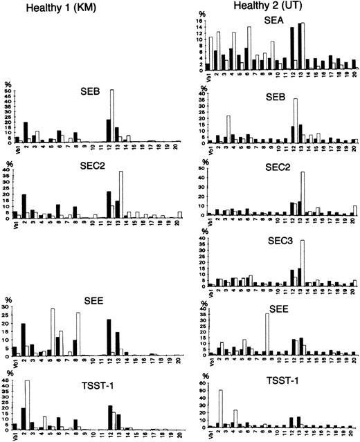 Fig. 1. Vβ repertoire stimulated with superantigens in healthy controls. (▪) Healthy donors as the control; (□) stimulated with a superantigen. Peripheral T cells were isolated from the blood of 2 donors and analyzed before or after in vitro stimulation with a bacterial superantigen (1 μg/mL) for 3 days. All of the toxins preferentially stimulated T cells expressing particular Vβs.27