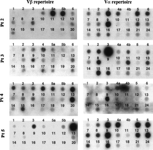 Fig. 2. Dot blotting of TCR Vβ and V repertoires of 5 patients with FHL. Fifteen microliters of products that was amplified by an inverse RT-PCR using the set of constant region primers was labeled by -32P-dCTP and hybridized to the Vβ and V filter prepared with 200 ng of each variable gene segment, respectively.