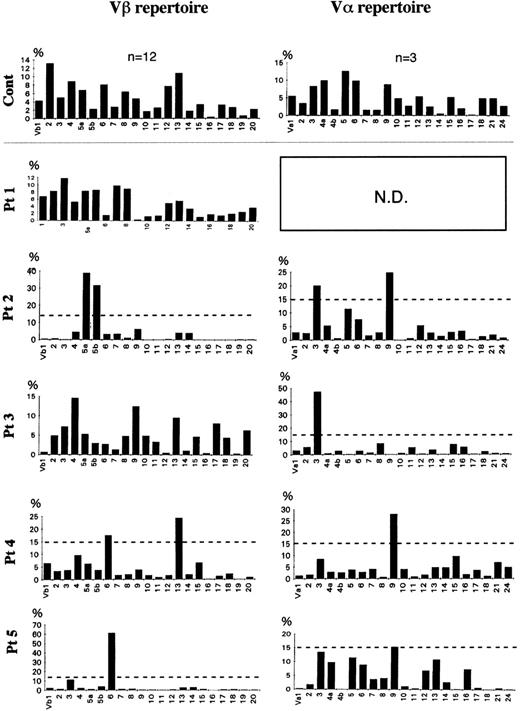 Fig. 3. Frequency of TCR Vβ and V family in FHL patients. With densitometry, a semiquantitative assessment of V gene usage was made from the amount of hybridized products. The dotted line shows 15% of β-T cells. TCR V gene segments were regarded as highly expressed when their relative frequency was more than 15%. A highly expressed Vβ family member was observed in 3 of the 5 patients: Vβ5a and 5b of patient no. 2 and Vβ6 of both patients no. 4 and 5. A high frequency of a V family member was detected in all 5 patients: V3 and 9 in patient no. 2, V3 in patient no. 3, and V9 in patients no. 4 and 5.