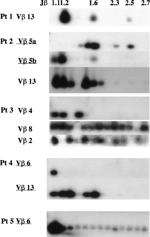 Fig. 5. Frequency of Jβ usage in Vβ repertoire in FHL patients. Autoradiograms were scanned by computerized densitometry, providing an absolute value for each autoradiographic spot. Each Vβ-Jβ spot is expressed as a percentage of the sum of all of the respective Vβ-Jβ signals detected on the autoradiogram. Some Vβ family members expressed within the normal range were also investigated in each patient. In the TCR V genes with a high frequency (15%), only 1 member of the Jβ1 gene subgroup was highly expressed in 3 patients. Even among the other Vβ family members expressed within the normal range, 1 of Jβ1 with overexpression and Jβ prediposed bias were observed: Vβ13 in patient no. 1, Vβ3 and 4 in patient no. 3, Vβ1 and 15 in patient no. 4, and Vβ13 in patient no. 5.