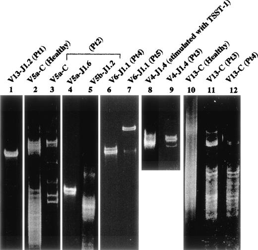 Fig. 7. Clonality by SSCP analysis. Healthy peripheral blood mononucler cells (PBMC) as a control were investigated. Lane 2 (Vβ5a-Cβ) and lane 10 (Vβ13-Cβ); lane 8, Vβ4-Jβ1.4 of healthy PBMC stimulated with TSST1; lane 1, Vβ13-Jβ1.2 in patient no. 1; lanes 3, 4, and 5, Vβ5a-Cβ, Vβ5a-Jβ1.6, and Vβ5b-Jβ1.2 in patient no. 2, respectively; lanes 6 and 12, Vβ6-Jβ1.1 and Vβ13-Cβ in patient no. 4, respectively; lane 7, Vβ6-Jβ1.1 of bone marrow in patient no. 5; lanes 9 and 11, Vβ4-Jβ1.4 and Vβ13-Cβ in patient no. 3, respectively. Smears are shown in lanes 2, 5, 8, 10, 11, and 12. Distinct bands are observed in lanes 3, 4, 6, 7, 9, and 1, suggesting clonal expansion.
