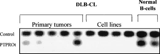Fig. 5. Semiquantitative duplex RT-PCR analysis of PTPROt in primary DLB-CLs, DLB-CL cell lines and normal splenic B cells. Five primary DLB-CLs, 4 DLB-CL cell lines (DHL-4, DHL-7, DHL-8, and DHL-10), and normal unsorted splenic B cells from 2 donors were analyzed for PTPROt expression by semiquantitative duplex RT-PCR. The abundance of PTPROt in a given sample was determined by comparing the intensity of coamplified PTPROt and ABL PCR products.