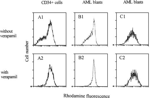 Fig. 3. After a 1-hour incubation with rhodamine, cells were exposed for 2 hours to dye-free medium without (1) or with (2) verapamil to allow rhodamine efflux. Distribution of rhodamine content of normal CD34+ cells (A) and AML blasts (B and C) was measured by flow cytometry. Efflux inhibition by verapamil (2) resulted in an increase of rhodamine content in cells with MDR expression.