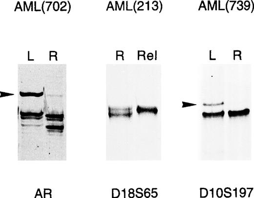 Fig. 1. Microsatellite alterations in adult acute leukemias. PCR amplification of the indicated microsatellites was performed as described in Materials and Methods on genomic DNA of AML patients at diagnosis (L) or relapse (Rel), and the resulting banding patterns were compared with those obtained at remission (R). Tumor-specific alterations consisted either of gain of new-length alleles (MSI), indicated by arrows, or loss of bands detected in constitutional DNA (LOH).