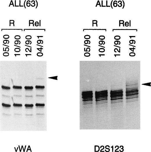 Fig. 3. MSI as impending relapse marker in ALL. In 1 ALL case (63), MSI was observed by PCR analysis in 2 different loci (vWA, D2s123) at both early (lane 12/90) and full (lane 04/91) relapse. Tumor-specific alterations are indicated by arrows. R, remission; Rel, relapse.