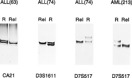 Fig. 6. LOH involving mismatch repair genes loci; some representative alterations are shown. Genomic DNA from ALL patients 63, 74, and AML patient 213 was PCR-amplified for microsatellites D3S1611, CA21, and D7S517, 3 genetic markers respectively associated with the MLH1, MSH2, and PMS2 genes, as reported in Materials and Methods. R, remission; Rel, relapse.