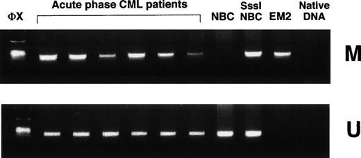 Fig. 3. Methylation-specific PCR shows ABL1 methylation patterns in clinical samples from acute-phase CML. NBC, normal donor buffy-coat DNA; SssI-NBC, CpG methylase (SssI methylase)-treated normal donor buffy-coat DNA; EM2, CML cell line EM2. Native DNA lane contains DNA that was not modified by bisulfite. M, primers specific for methylated DNA; U, primers specific for unmethylated DNA; ◊x, ◊x/HaeIII marker.