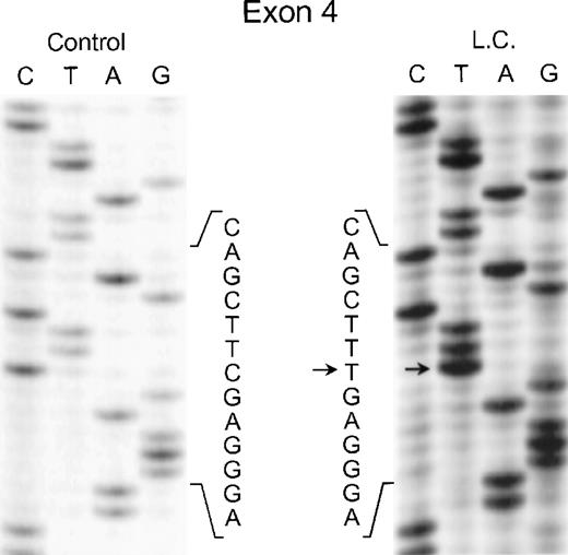 Fig. 2. Sequence analysis of PCR-amplified exon 4 of the p67-phox gene from genomic DNA in patient LC. Sequences of patient and control are shown. The arrows indicate the C to T transition. The 5′ end of the DNA is at the top of each sequencing panel.