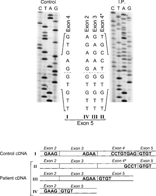 Fig. 5. Sequence analysis of p67-phox cDNA in patient IP. The region between exons 2 and 5 was amplified by PCR using primers p67-94LcDNA and p67-455RcDNA. The upper panel shows the sequences of the patient and control with the 5′ end of the cDNA sequence at the top. The dashed line indicates the beginning of exon 5, the point at which the cDNA sequence returns to normal after the 3 abnormal types of splicing (splice versions labeled II, III, and IV). The lower panel shows a diagram of the different cDNA molecules derived from the alternative splicing. The GT dinucleotide in the 3′ end of exon 4 in the normal cDNA species (version I) is the cryptic splice site used for generating the abnormally spliced version II (exon 4*).