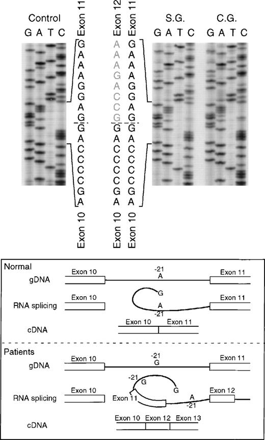 Fig. 6. Sequence analysis of p67-phox cDNA in patients SG and CG. The region between exons 10 and 14 was amplified by PCR using primers p67-835LcDNA and p67-1102RcDNA. The upper panel of the figure shows the cDNA sequences of a normal control and patients SG and CG with the 3′ end at the top. The dashed line indicates the 3′ end of exon 10 and the beginning of 2 different sequences in each patient. The lower panel of the figure shows a schematic representation of the splice defect produced by the nt substitution in the branch point sequence of intron 10. The A → G transition at position −21 of intron 10, important for RNA lariat formation, produces a partial defect in splicing of exon 11 that can allow alternative splicing between exons 10 and 12.