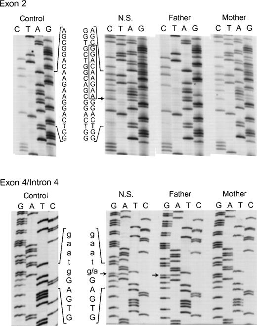 Fig. 8. Genomic DNA sequence analysis of exon 2 (upper panel) and the exon 4/intron 4 region (lower panel) of the p67-phox gene from patient NS and her parents. In the upper panel, the box indicates the 9 nts deleted from the normal exon 2 sequence seen in both NS and her mother. The arrow adjacent to the box indicates the site where the 9-nt deletion starts in exon 2. The 5′ end of the DNA is at the top. In the lower panel, the arrows indicate the g → a transition in the first nt in intron 4 seen in both NS and her father. The upper case letters represent exon 4 sequence, while lower case letters indicate the intronic sequence. The 3′ end of the DNA is at the top of this panel.