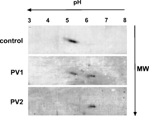 Fig. 2. Two-dimensional gel electrophoresis of PV and control platelet Mpl. A total of 25 μg of platelet lysate protein was subjected to isoelectric focusing in the first dimension (horizontal axis) followed by 10% acrylamide SDS-PAGE in the second dimension (vertical axis), transferred to a nitrocellulose membrane, and immunoblotted with the Mpl C-terminal peptide antiserum.