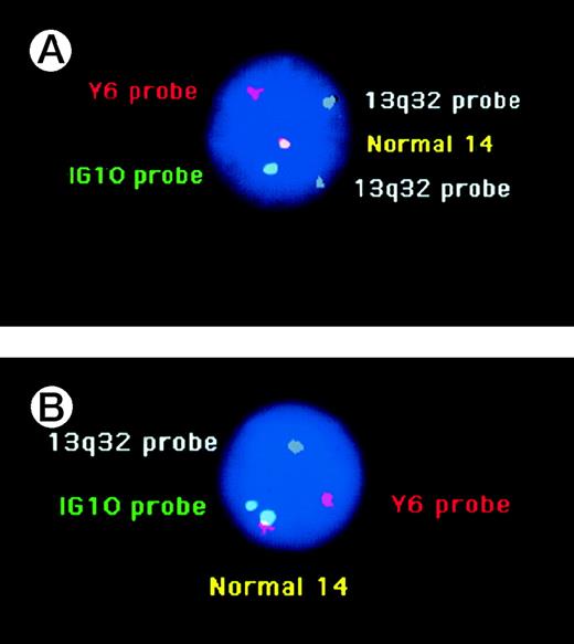 Fig. 2. (A) Analysis of a purified plasma cell of MGUS individual no. 16, using the Y6, IG10, and 13q32 probes. The yellow signal corresponds to the fusion of 1 green (IG10 probe) and 1 red (Y6 probe) on a normal chromosome 14. The second chromosome 14 is rearranged, because the Y6 and the IG10 probes are separated. This clonal plasma cell is disomic for chromosome 13 (2 white signals). (B) Another plasma cell of the same patient. In contrast to the cell shown in (A), this clonal plasma cell (with an illegitimate IGH rearrangement) displays deletion 13q (only 1 white signal).