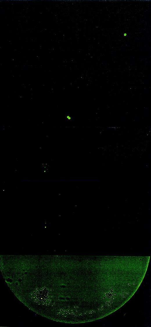 Fig. 2. Divisional history of 1 single CD34+/CD38− cell stained with PKH26, derived from an FLV sample. At 0 hour, a cell showing bright fluorescence is depicted. At 38 hours, the cell has divided, yielding 2 daughter cells with bright PHK26 fluorescence. At 98 hours, 1 cell has maintained bright fluorescence among 32 cells with dim fluorescence. On day 8 (at 194 hours), 1 cell with bright fluorescence has remained among several hundreds of other cells. The upper 4 pictures were taken with fluorescence microscopy. The bottom picture shows the same cell culture on day 8 in both phase contrast and fluorescence microscopy.