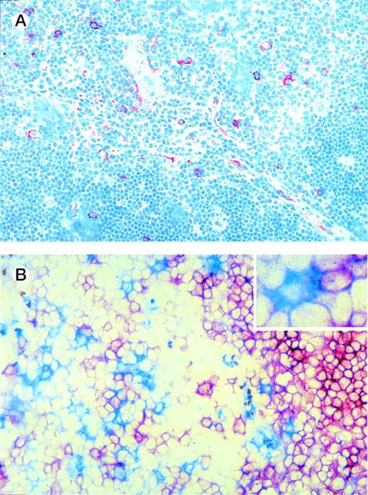 Fig. 4. Thymic localization of DC precursors. (A) Thymic tissue sections were incubated with anti-IL3R MoAb and counterstained with hematoxylin. IL-3Rhigh cells (red), which comprise DC precursors, are predominantly located in the medulla and a few are scattered through the cortex. (B) Thymic tissue sections were double-stained for IL-3R and CD1a. IL-3Rhigh cells (blue) are often found adjacent to CD1a+ thymocytes (red) (see inset). Original magnification (A) ×200, (B) ×400.