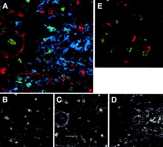 Fig. 5. The medulla contains both DC precursors and mature DC. Thymic tissue sections were triple-stained with anti-IL–3R (red), anti-CD83 (green), and anti-CD86 (blue). Patterns of the individual colors, which combined are shown in (A), are depicted separately in (B) (anti-CD83), (C) (anti-IL-3R ), and (D) (anti-CD86). As a comparison in (E), a control staining of anti-IL–3R (red), anti-CD83 (green), and control IgG (blue) is included. The round structure on the left side represents a Hassall’s corpuscle, which indicates the thymic medulla. Note in (A) the red stained pre-DC versus the blue/green stained mature DC. Original magnification ×400.