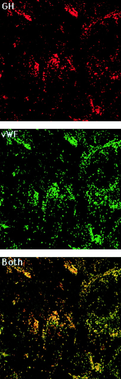 Fig. 1. Colocalization of GH with vWF. GHrAd-infected HUVEC were fixed, permeabilized, and stained with rabbit anti-GH antibody followed by rhodamine-conjugated sheep antirabbit antibody and then FITC-conjugated sheep anti-vWF antibody. Images were obtained by scanning confocal microscopy at 0.36-μm intervals in the Z-axis using a 100× objective. Shown is a representative scan from the approximate midsection of the Z-axis. The red and green images were merged to demonstrate colocalization, which appears yellow.