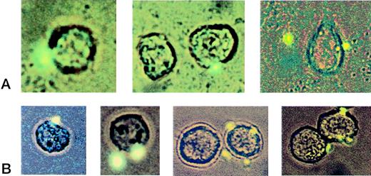 Fig. 6. Visualization of platelet/THP-1 complexes. Fluorescently labeled activated platelets were added to the suspension of nonlabeled THP-1 cells in a ratio of 3:1. Complex formation between platelets and THP-1 cells was assessed by combined light and fluorescence microscopy. The panels in row (A) depict micrographs of THP-1/platelet complexes adhering to the endothelial monolayer (40×). Row (B) shows typical examples of sparsely decorated THP-1 cells in the suspension after passage through the flow chamber (40×).