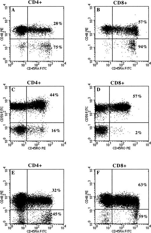 Fig. 3. Representative dot plots comparing CD45RA and CD45R0 expression by normal (CD48+) and PNH (CD48−) lymphocytes for CD4+ (T-helper) and CD8+ (T-cytotoxic) populations. Plots A and B show that the proportion of CD45RA+ cells is significantly higher (75% and 94%, respectively) for PNH components of the CD4+ and CD8+ subpopulations when compared with the residual normal components (28% and 57%, respectively), which are predominantly CD45RA−. Plots C and D are representative examples comparing CD45R0 expression by normal (CD59+) and PNH (CD59−) lymphocytes for CD4+ (T-helper) and CD8+ (T-cytotoxic) populations. As expected, the proportion of CD45R0+ cells is significantly lower (16% and 2%, respectively) for PNH components of the CD4+ and CD8+ subpopulations when compared with the normal components (44% and 57%, respectively). Plots E and F show the proportions of CD45RA+ components within the normal and PNH fractions of the CD4+ and CD8+ lymphocyte subsets of patient PNH030, who had a spontaneous remission of PNH 20 years ago. The plots show normal distributions of naive (CD45RA+) and memory cells (CD45RA−) for all populations.