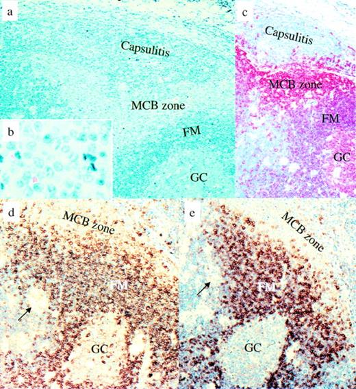 Fig. 1. Piringer’s lymphadenopathy. Morphological and immunophenotypical features of monocytoid B cells in comparison with other B-cell populations. (a and b) Giemsa staining. (c) CD20 immunostaining: mantle cells and germinal center B cells are less intensively stained than the monocytoid B cells and display a slightly different red tone. (d) IgM immunostaining: monocytoid B cells are largely negative for IgM, which is different from the strongly IgM-positive follicle mantle cells. (e) IgD immunostaining. Only some monocytoid B cells are positive for IgD. Arrows show small clusters of epithelioid cells characteristic of Piringer’s lymphadenopathy. MCB, monocytoid B cells; FM, follicle mantle; GC, germinal center.