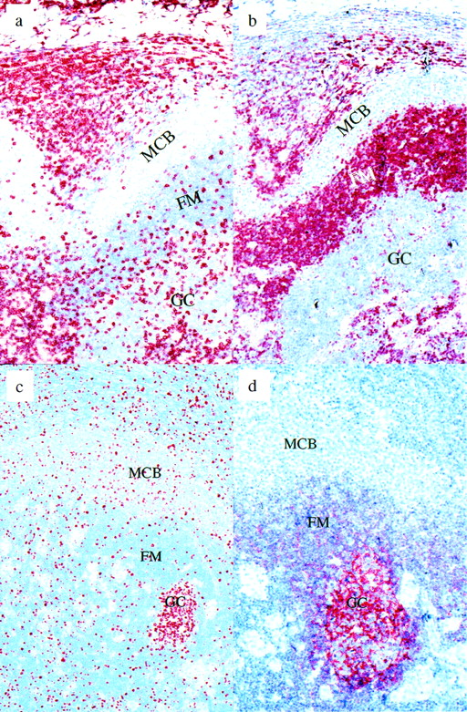 Fig. 2. Piringer’s lymphadenopathy. (a) CD3 immunostaining: the monocytoid B-cell zone is nearly devoid of T cells, in contrast to the follicle mantle and germinal center. (b) BCL-2 immunostaining: monocytoid B cells are negative for BCL-2. (c) Ki-67 immunostaining: approximately 10% to 20% of the monocytoid B cells are in cell cycle. (d) CD21 immunostaining. Note the labeling of follicular dendritic cells within the germinal center and their absence from the monocytoid B-cell zone. MCB, monocytoid B cells; FM, follicle mantle; GC, germinal center.