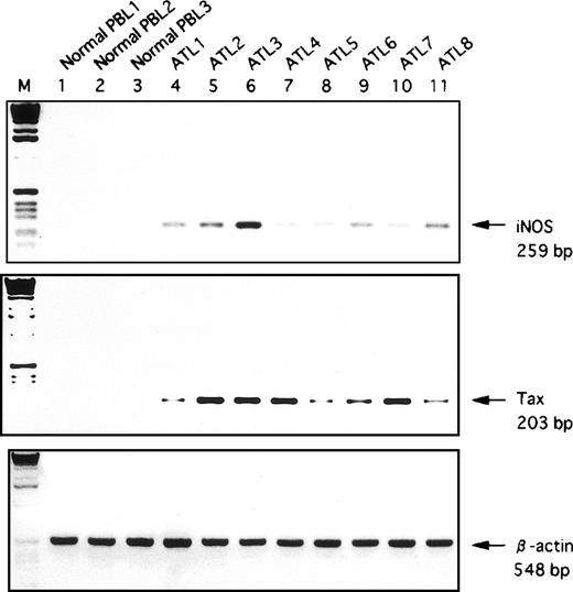 Fig. 2. Detection of hiNOS and Tax mRNA in fresh ATL samples by RT-PCR analysis. Lanes 1-3, normal PBL RNA; Lanes 4-11, PBL RNA samples from patients with ATL. Bottom, ethidium bromide staining of the RT-PCR performed with β-actin primers. Arrows indicate the position of the specifically amplified DNA.
