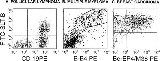 Fig. 2. SLT-1 binding by malignant B cells, breast carcinoma cells and HPC. Representative views from the flow cytometric detection of SLT-1 receptors on follicle center lymphoma grade I (A), multiple myeloma plasma cells (B), and breast carcinoma (C). The binding of FITC-SLT-B is shown in relation to anti-CD19 labeling (a pan-B–cell marker) for the lymphocyte gate in (A) or against B-B4 (plasma cell marker) for BM cells in (B) and against the combined expression of Ber-EP4 and M38 (MUC1) for a breast cancer biopsy (C). Dual-positives are shown in the upper right quadrant (A and C) or as a boxed area (B).
