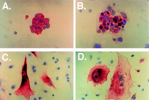 Fig. 3. Immunocytochemical analysis of breast cancer cells (A through D, immunohistochemical stain shown in red and nuclear counterstain in blue). Cytospins of cells from a breast cancer biopsy were stained with anti-LMWK (A, original magnification × 400) and anti-CD77 (B, original magnification × 400). The metastatic breast cancer cell line JS1 was grown on plastic slides and stained with anticytokeratin AE1/AE3 (C, original magnification × 400) and anti-CD77 (D).