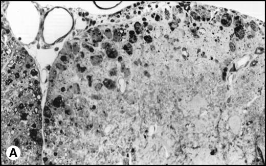 Fig. 5. (A) Histology of SJL/J spinal cords from mice infected with TMEV. Section of spinal cord of an SJL/J mouse, 130 days after infection with TMEV. The right anterior column is completely demyelinated and numerous large lipid-laden macrophages are present close to the central sulcus. The gray uniform background reflects conspicuous gliosis in the demyelinated area (1-μm–thick, Epon-embedded section, stained with toluidine blue; original magnification × 220). (B) Section from spinal cord of an SJL/J mouse 130 days after infection with TMEV and after treatment with radiation and BMT. Inflammatory cells are still around the large venule in the parenchyma of the left anterior column, indicating active disease, but many axons are still surrounded by myelin sheaths and gliosis is less prominent (1-μm–thick, Epon-embedded section, stained with toluidine blue; original magnification × 220).