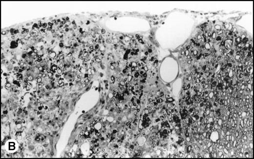 Fig. 5. (A) Histology of SJL/J spinal cords from mice infected with TMEV. Section of spinal cord of an SJL/J mouse, 130 days after infection with TMEV. The right anterior column is completely demyelinated and numerous large lipid-laden macrophages are present close to the central sulcus. The gray uniform background reflects conspicuous gliosis in the demyelinated area (1-μm–thick, Epon-embedded section, stained with toluidine blue; original magnification × 220). (B) Section from spinal cord of an SJL/J mouse 130 days after infection with TMEV and after treatment with radiation and BMT. Inflammatory cells are still around the large venule in the parenchyma of the left anterior column, indicating active disease, but many axons are still surrounded by myelin sheaths and gliosis is less prominent (1-μm–thick, Epon-embedded section, stained with toluidine blue; original magnification × 220).