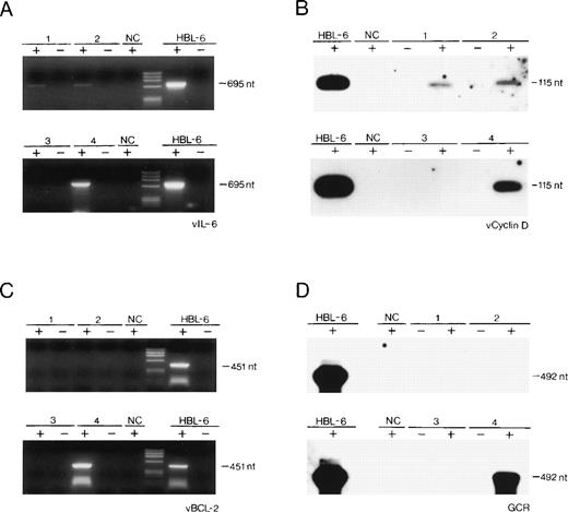 Fig. 1. (A through D) Detection by RT-PCR of the expression of cell-homologous genes of HHV-8 in 2 cases of reactive lymphadenopathy (lanes 1 and 2), in 1 case of localized CD of HV type (lane 3), in 1 case of multicentric CD of PC type (lane 4), and in 1 PEL cell line (HBL-6). NC, Raji cell line DNA. Negative controls included RT-PCR performed on RNA in the absence of reverse transcription reaction (−). nt, nucleotides; phiX174 HaeIII digested as molecular marker.