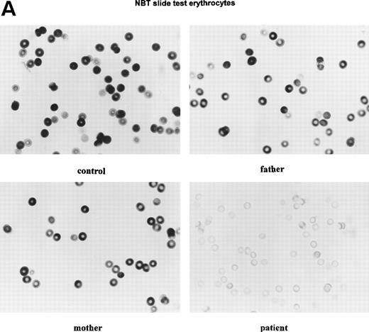 Fig. 4. Cytochemical localization of G6PD activity in erythrocytes from the patient with G6PD Volendam and her family. The test was performed as described.12 G6PD activity in individual erythrocytes was analyzed as production of formazan by reduction of tetra NBT and quatitated by means of cytophotometry through a microscope. The mean integrated absorbance per cell was measured in 50 randomly chosen cells, corrected for aspecific light loss in cells incubated in the absence of glucose 6-phosphate and expressed in activity grades from 1 to 10 (grade 1 = 0 to 10 arbitrary units, grade 2 = 10 to 20 arbitrary units, etc, up to grade 10 = 90 to 100 arbitrary units). (A) Histochemical localization of G6PD activity in erythrocytes from a healthy control, the father and mother of the patient, and the patient herself. Original magnification x 400. (B) Quantitative scores of these reactions are shown for the control, the father, the mother, and the patient.