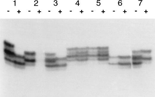 Fig. 5. Segregation of a skewed pattern of X-chromosome inactivation. The autoradiograph shows the results of amplification of the HUMARA polymorphism either without (−) or with (+) prior digestion with HpaII. Each allele appears as a doublet. With reference to the family tree in Fig 1, the subjects analyzed are as follows: 1 =II:13 (mother of the patient); 2 = II:4 (father of the patient); 3 = III:2 (patient); 4 = III:4 (sister of the patient); 5 = III:5 (sister of the patient); 6 = IV:1 (daughter of the patient); 7 = IV:3 (daughter of the patient). Notice that 1, 3, and 7 show a skewed pattern of X-chromosome inactivation, 4 and 5 are random, and 6 is uninformative.