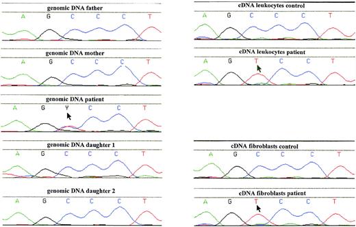 Fig. 3. Analysis of genomic and complementary DNA from the patient with G6PD Volendam and her family. A PCR product, containing the region around 514C of the G6PD gene, was generated from genomic or cDNA obtained from blood leukocytes or cultured fibroblasts, and was analyzed by Dye Primer Cycle sequencing. Starting material: left, genomic DNA from leukocytes of the father and the mother of the patient, the patient, and her 2 daughters; right, cDNA from leukocytes of a healthy control and the patient; and cDNA from cultured fibroblasts of a healthy control and the patient. Arrows indicate mutant sequence.