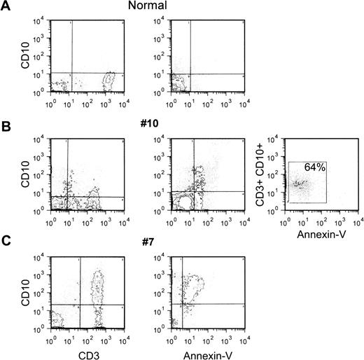 Fig. 8. Expression of CD10 by apoptosing peripheral blood T cells from HIV-seropositive patients. Peripheral blood MNC from 1 normal control or 2 HIV-seropositive patients were double or triple stained as indicated in Fig 6, and analyzed by flow cytometry. The quadrants were drawn based on the analysis of negative controls stained with an irrelevant (isotype-matched) MoAb or in the absence of Annexin-V-FITC.