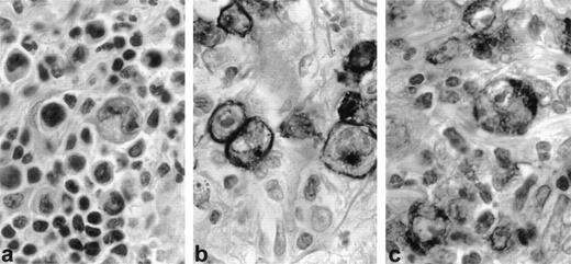 Fig. 1. CD30 and CD30 ligand (CD30L) expression in regressing lesion (LyP, patient no. 1). Immunohistochemistry on paraffin sections. (a) Typical histologic feature of LyP, type A: large, atypical blasts admixed with small, reactive lymphocytes (H&E, original magnification × 400). (b) CD30 staining is restricted to large neoplastic cells (anti-CD30, PAP method, original magnifica- tion × 400). (c) CD30L is mostly expressed by large neoplastic cells (anti-CD30L, PAP method, original magnification × 400).
