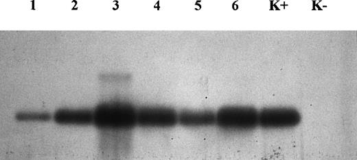 Fig. 3. Analysis of amplified DNA by Southern blot for CD30L. Note that lanes 3, 4, and 6 (regressing lesions) are thicker than lanes 1, 2, and 5 (growing lesions). Lanes 1 and 3 concern 2 different lesions (growing and regressing, respectively) from the same patient. K+, positive control; K−, negative control.