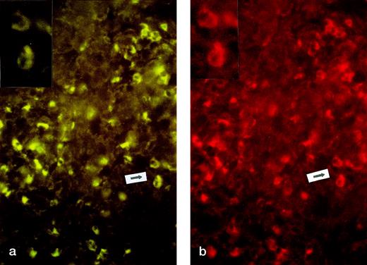 Fig. 2. CD30 and CD30L expression in regressing lesion (LyP, patient no. 4). Two-color immunofluorescence on frozen sections. (a) CD30 staining (FTIC, see Materials and Methods, original magnification × 200). Inset: particular of the area indicated by arrow. (b) CD30L staining (PE, see Materials and Methods, original magnification × 200). Inset: particular of the area indicated by arrow.