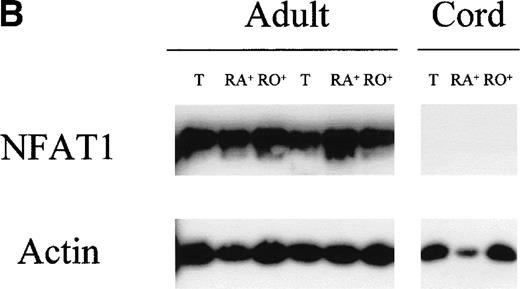 Fig. 1. Undetectable NFAT1 protein expression in unstimulated UCB T cells. (A) T cells were purified from fresh MNC of 6 UCB units (lanes 1 through 6) and from 3 adult PBMC (lanes 7 through 9). Protein extracts equivalent to 3 × 105 T cells were loaded per lane and analyzed by Western blotting with a combination of anti-NFAT1 and anti–β-actin antibodies. (B) T cells were further separated into CD45RA+ and CD45RO+ expressing cells and protein extracts analyzed as above.