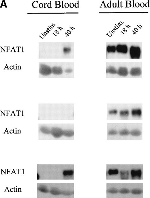 Fig. 2. Reduced upregulation of NFAT1 protein in UCB T cells during primary stimulation. (A) MNC from 2 UCB units and 2 adults were stimulated in parallel with Con A for 40 hours. At 0 hour (unstim), 18 hours, and 40 hours of stimulation, T cells were purified and extracted and NFAT1 protein expression analyzed by Western blotting. The results shown are representative of 5 independent experiments, comparing in each experiment 2 UCB and 2 adult controls analyzed together and run on the same gel. (B) Graphic representation of the mean (±SE) of the quantification of relative NFAT1 expression after stimulation with Con A. Gel loading was normalized for each lane with the actin band and the intensity of each NFAT1 band was calculated as relative percentage of the most intense NFAT1 band on each gel. The most intensive band was set arbitrarily at 100% and relative percentages were then averaged and graphed.