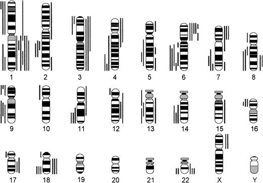 Fig. 6. Chromosomal imbalances in B-ib lymphomas (n = 28). Each bar indicates the gain (right side) or loss (left side) of the respective chromosomal region in 1 lymphoma case.