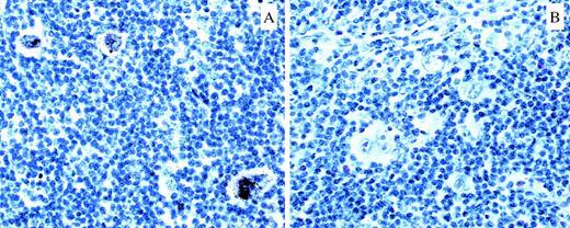 Fig. 1. mRNA expression of IκB in primary HRS cells of a patient with HD. (A) Hybridization with IκB antisense probe. Accumulation of silver grains over HRS cells (exposure time, 6 weeks). (B) Hybridization with IκB sense probe. No labeling of HRS cells.