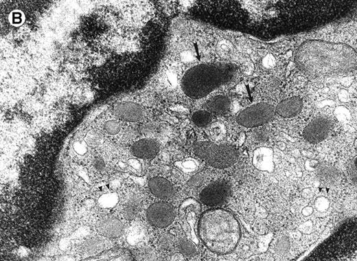 Fig. 1. Electron micrograph of a peripheral blood neutrophil from a C/EBPɛ−/−mouse (A and B) and a wild-type mouse (C). (A) The C/EBPɛ−/− peripheral blood neutrophil shows signs of immaturity; the absolute number of granules is reduced and tertiary, bacilliform-shaped granules are missing. (B) Higher magnification of middle section of C/EBPɛ−/− neutrophil: The ratio of the larger, primary (electron-dense) granules (arrows) to the smaller less electron-dense, secondary granules is increased. In the less mature C/EBPɛ−/− neutrophils, most secondary granules appear electron-lucent, most likely due to extraction by glutaraldehyde fixation (arrowheads) as previously described.46 (C) For comparison, mature wild-type granulocyte has multiple, small secondary granules (arrows) and bacilliform tertiary granules (arrowhead).