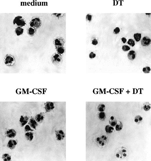 Fig. 6. Morphologic features of PMN cultured with GM-CSF in the presence or absence of DT. Only after GM-CSF treatment, PMN acquired sensitivity to DT, which induced typical apoptotic features. Cytospin preparations of PMN were stained using the May-Grünwald-Giemsa method after incubation in vitro for 21 hours in the presence or absence of 0.5 ng/mL GM-CSF with or without 10−8 mol/L DT. The experiment depicted is representative of 2.